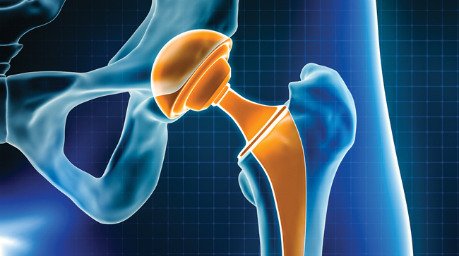 A digital representation of an artificial hip joint that's in place.