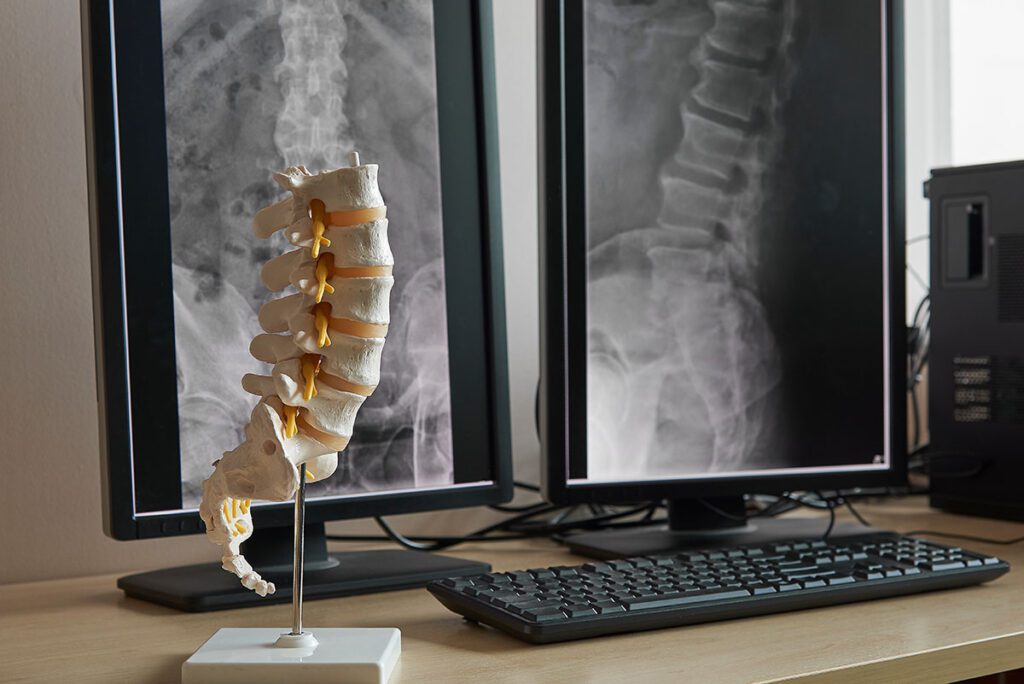 A human lumbar spine model sitting on a desk with x-rays of a person's lumbar spine in the background.