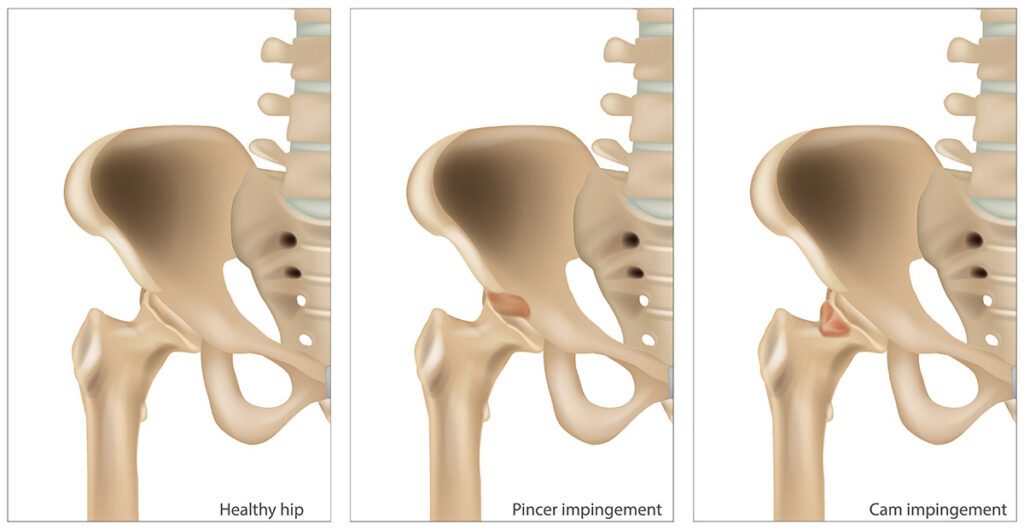 Various Hip Impingements compared to a healthy hip.